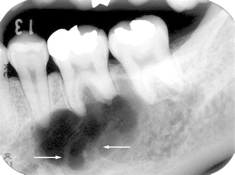 Periapical Cyst - Viewing Gallery