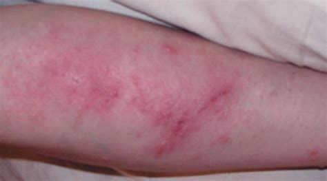 Poison Ivy Rash - Pictures, Treatment, Symptoms, Contagious, Duration