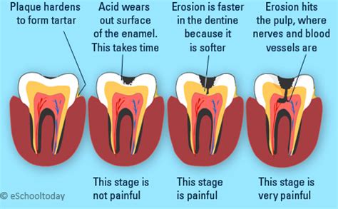 What is tooth decay. Causes of tooth decay