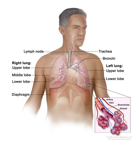 Lung Cancer Screening - NCI