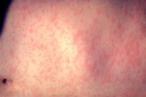 File:Morbillivirus measles infection.jpg - Wikipedia