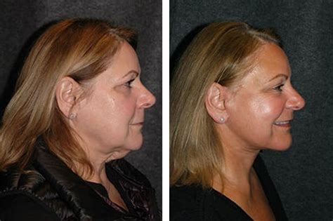 Lower Facelift New York | Lower Facelift and Necklift