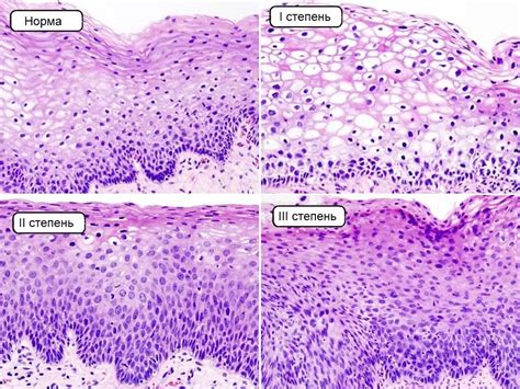 Cervical intraepithelial neoplasia: symptoms, grades, diagnosis, treatment | Women's he alth 2024