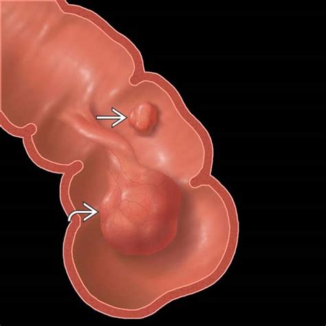 Colonic Polyps | Radiology Key