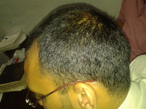 Alopecia Areata Homeopathic Treatment, Homeopathic Medicines