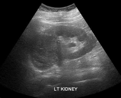 Kidney Tumor Ultrasound