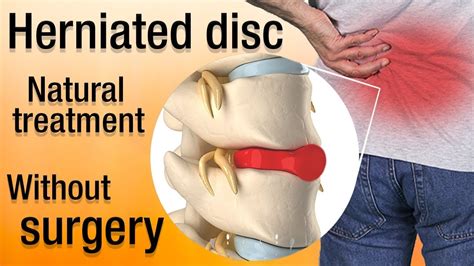 Herniated Disc Treatment