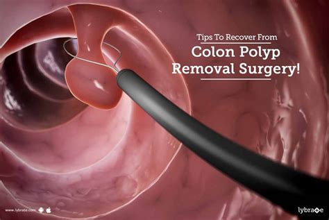 Tips To Recover From Colon Polyp Removal Surgery! - By Dr. Avaneesh Hasiza | Lybrate