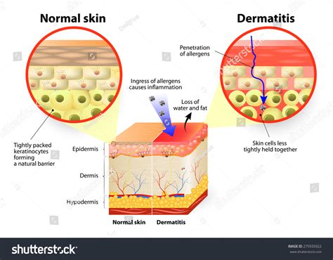 Skin Disease. Dermatitis Or Eczema. Labeled Diagram Stock Vector Illustration 275935922 ...