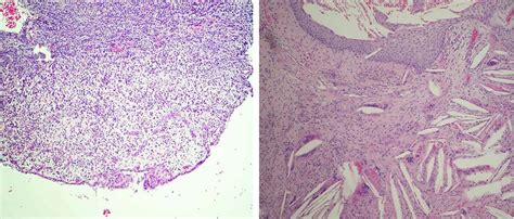 Histology Periapical Cyst