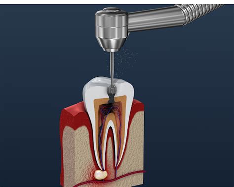 Root Canal Pain Signs and Symptoms | Bridge Creek Dental