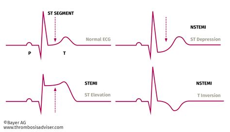 Stemi Vs Nstemi Diagram