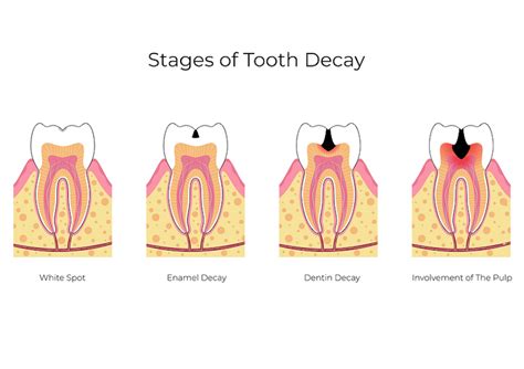 The Five Stages of a Cavity - General Dentistry | The Billings Dentist