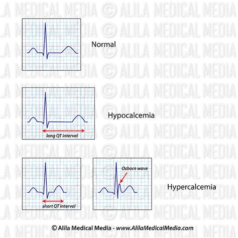 Alila Medical Media | Hypercalcemia and hypocalcemia ECG | Medical ...