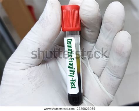 Blood Sample Serum Osmolality Test Diagnosis Stock Photo 2225823055 | Shutterstock