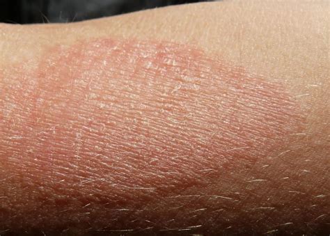 Eczema: Symptoms, treatment, and causes