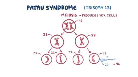 Celebrities With Trisomy Syndrome Patau Syndrome | The Best Porn Website