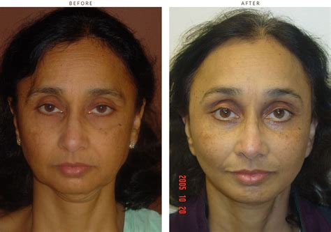 Mid Face Lift – Before and After Pictures * – Dr Turowski – Plastic Surgery Chicago