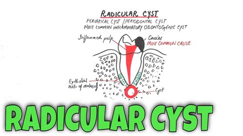 Radicular cyst / Periapical Cyst - Pathogenesis, Clinical, RF, HF ...