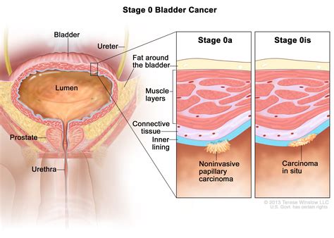 Bladder Cancer Stages - NCI