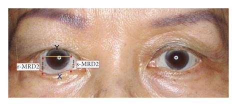 Lower lid real scleral show calculation. | Download Scientific Diagram
