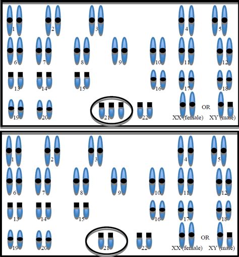 Mosaic Down Syndrome Karyotype