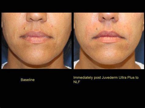 Juvederm Ultra Plus Vs Voluma Lips | Lipstutorial.org