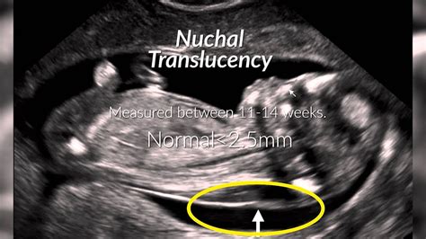 Down Syndrome Baby Ultrasound