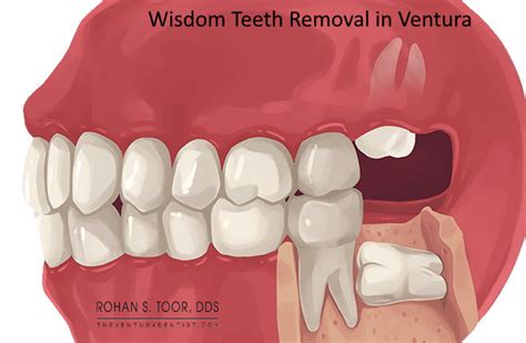 Ventura - Wisdom Teeth Removal - Cost, Symptoms, Recovery, Oral Surgery - CA - Rohan Toor Dental ...