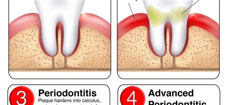 Periodontitis – causes, symptoms, treatment [WE EXPLAIN] – Healthy Food Near Me