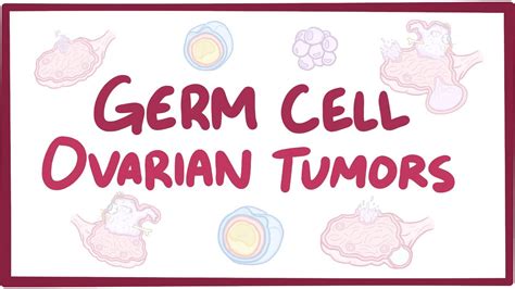 Germ cell ovarian tumor: Video, Causes, & Meaning | Osmosis