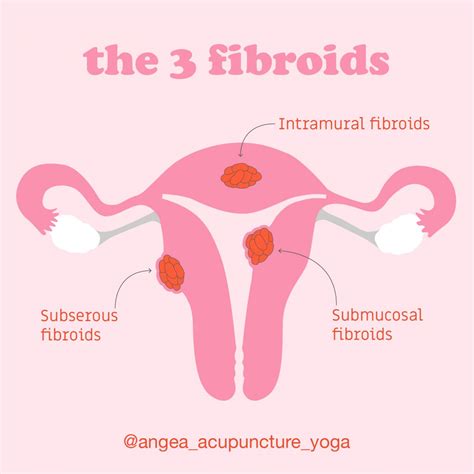 Fibroids Cks