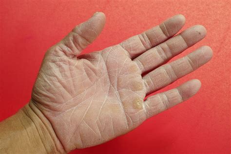 Hand Care: 3 Helpful Tips for Dealing with Dry Skin on Hands