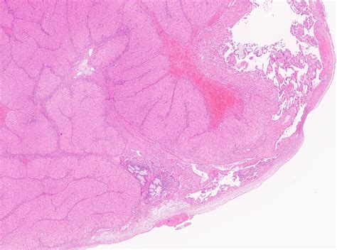 F32y/o. HEMOPERITONEUM. VERY INTERESTING CASE . What is your Dx? | KiKo XP