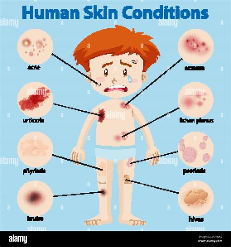 Diagram showing different skin conditions illustration Stock Vector Image & Art - Alamy