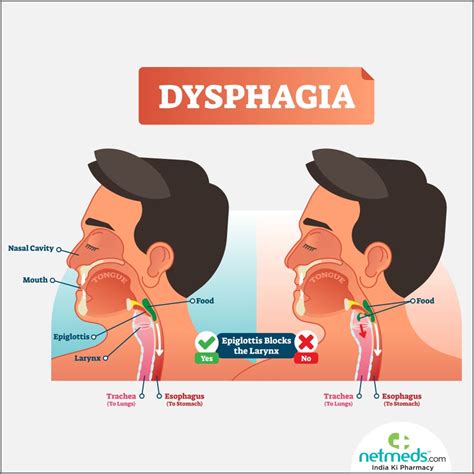 Dysphagia: Causes, Symptoms And Treatment | Netmeds