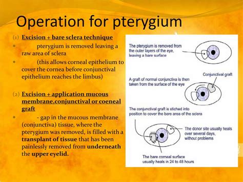 PPT - PTERYGIUM PowerPoint Presentation, free download - ID:1866965