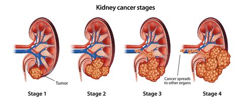 Kidney Cancer (Renal Cancer) Signs, Symptoms | Saint John’s Cancer Institute - Santa Monica, CA