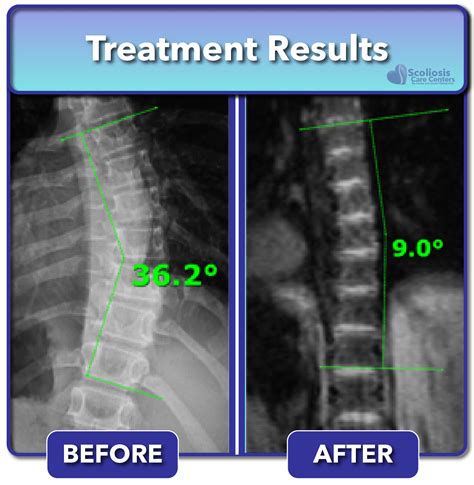 Scoliosis Before And After