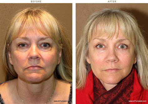 Mid Face Lift – Before and After Pictures * – Dr Turowski – Plastic Surgery Chicago