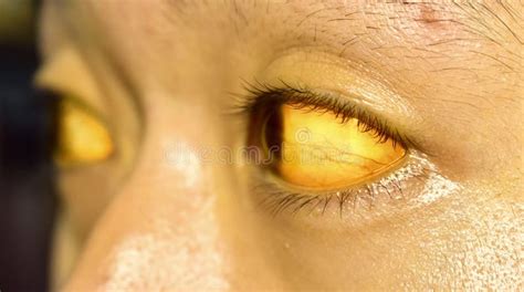 Yellowish Discoloration of Skin and Sclera or Deep Jaundice in Face of ...