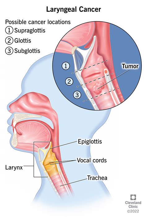 Understanding Laryngeal Cancer: Symptoms, Treatment, And Prevention - Ask The Nurse Expert