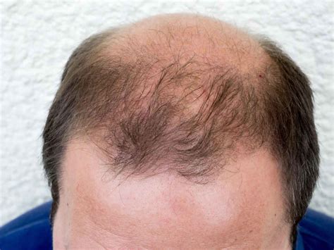 Androgenetic alopecia female & male causes, diagnosis & treatment