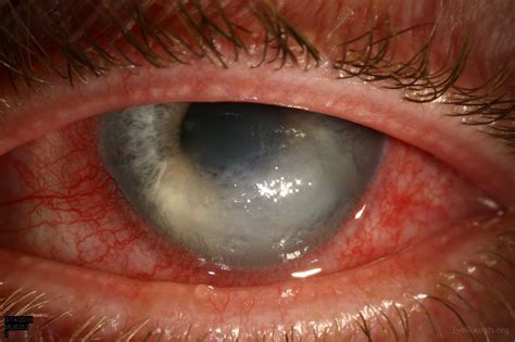 Corneal Hydrops