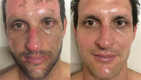 Scott’s Scarring Story - Acne Scar Treatment by DMK