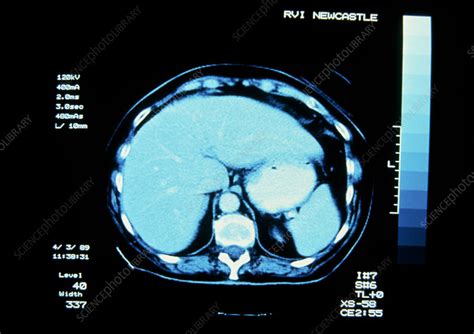 CT scan of normal liver - Stock Image - P530/0030 - Science Photo Library