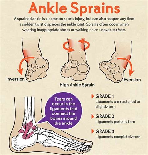 Ankle Sprain : Causes, Treatment & Prevention | ReLiva Physiotherapy & Rehab