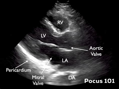 eFAST Ultrasound Exam Made Easy: Step-By-Step Guide - POCUS 101 (2022)