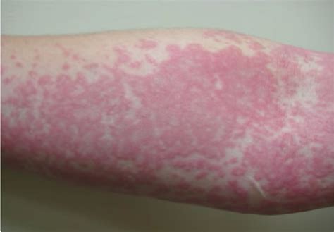 Have You Ever Gotten A Rash From The Sun? You Might Be Allergic