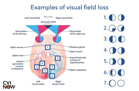 The visual pathway from the eye to the brain – Perkins School for the Blind